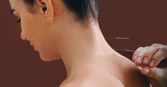 Pain Management Acupuncture image