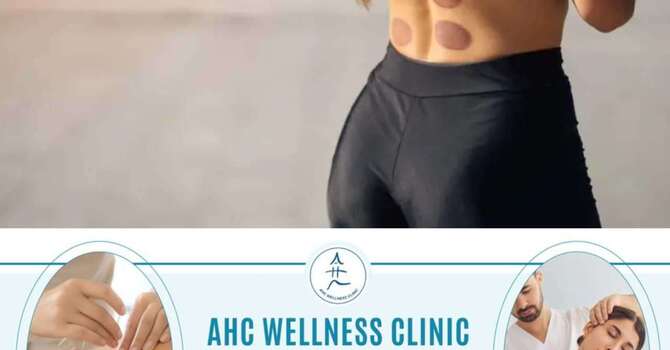 What is Cupping Therapy image