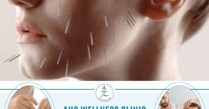 Cosmetic Acupuncture image