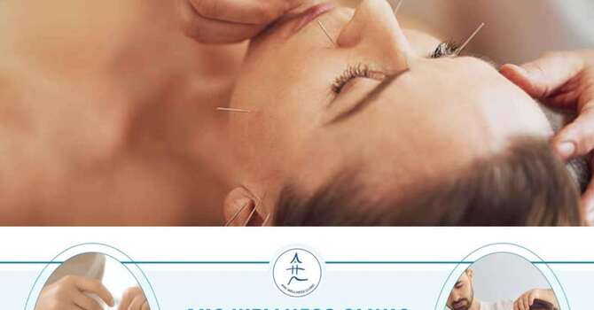 Stress & Anxiety Relief Acupuncture image